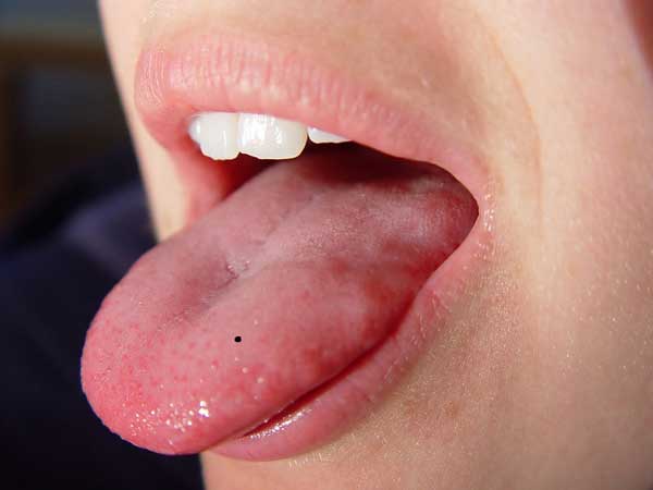 Bói nốt ruồi ở lưỡi có ý nghĩa gì?