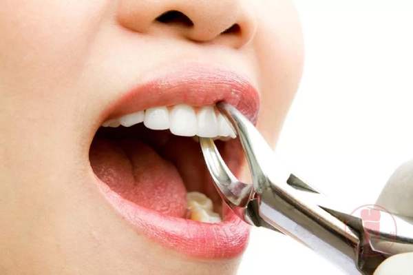 Liệu nhìn thấy nhổ răng có phải dấu hiệu xui xẻo không?