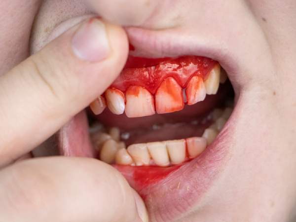 Chiêm bao thấy bị đánh nhau chảy máu răng tốt hay xấu?